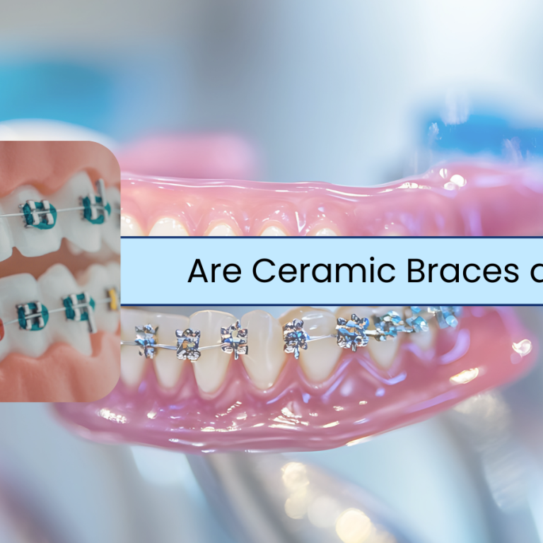 Are Ceramic Braces a good option