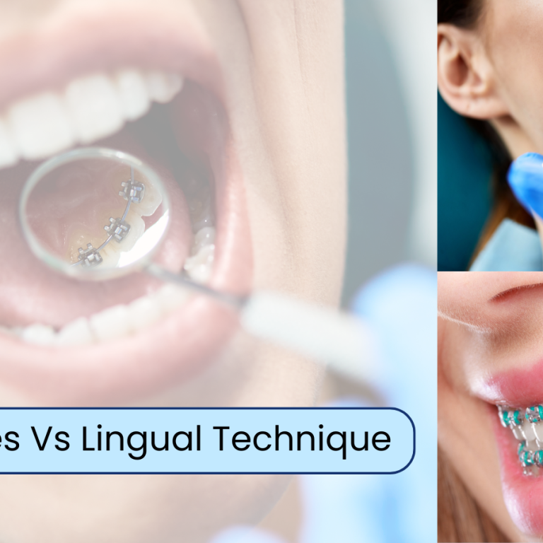 Ceramic Braces & Lingual Technique